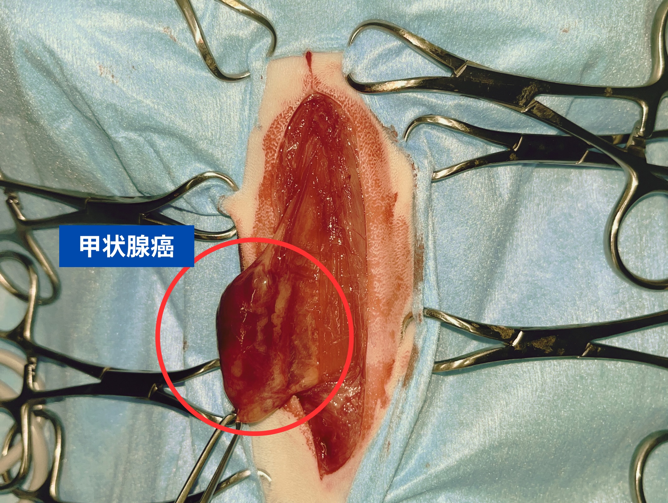 甲状腺癌術中写真