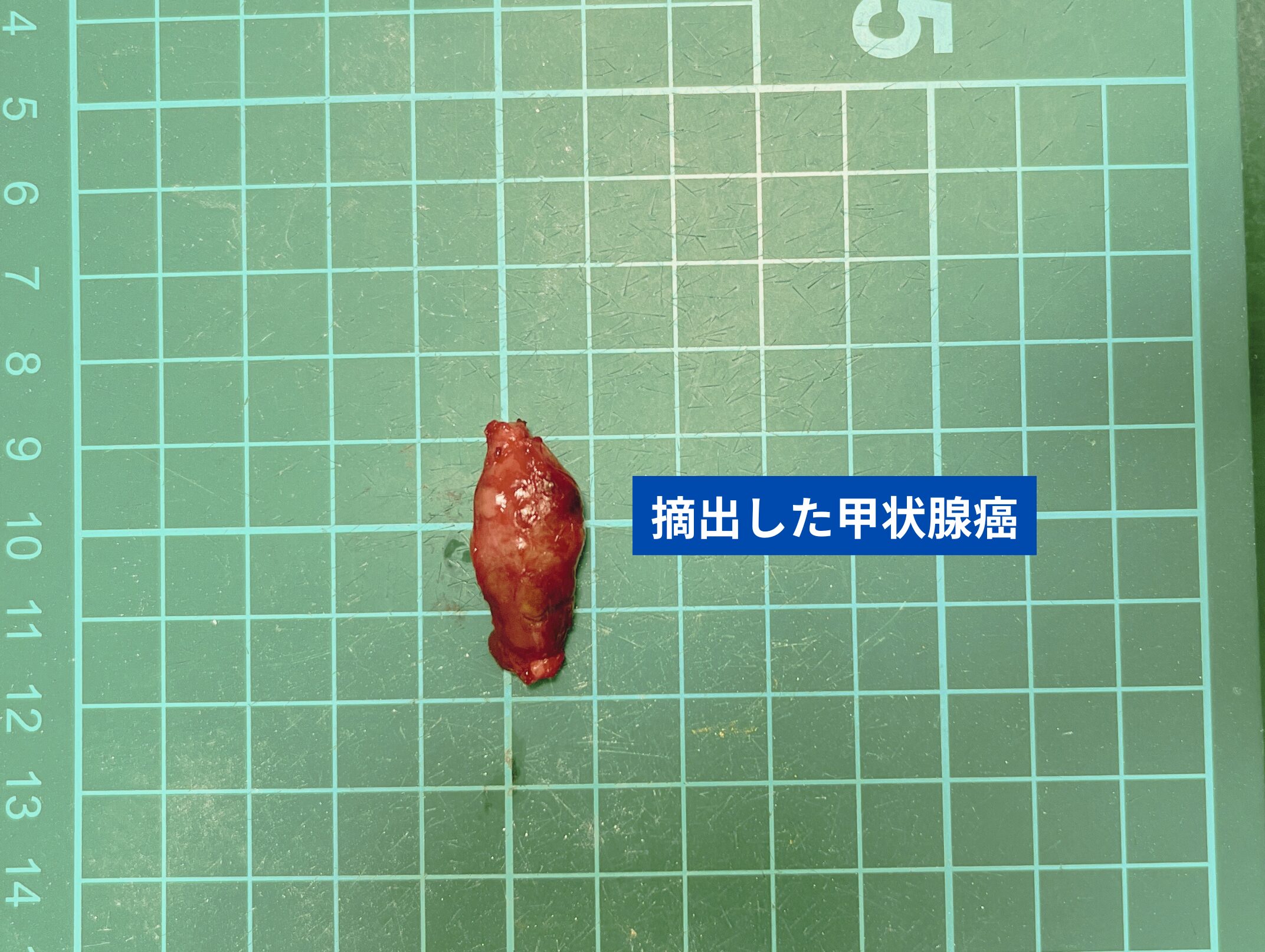 摘出した甲状腺癌