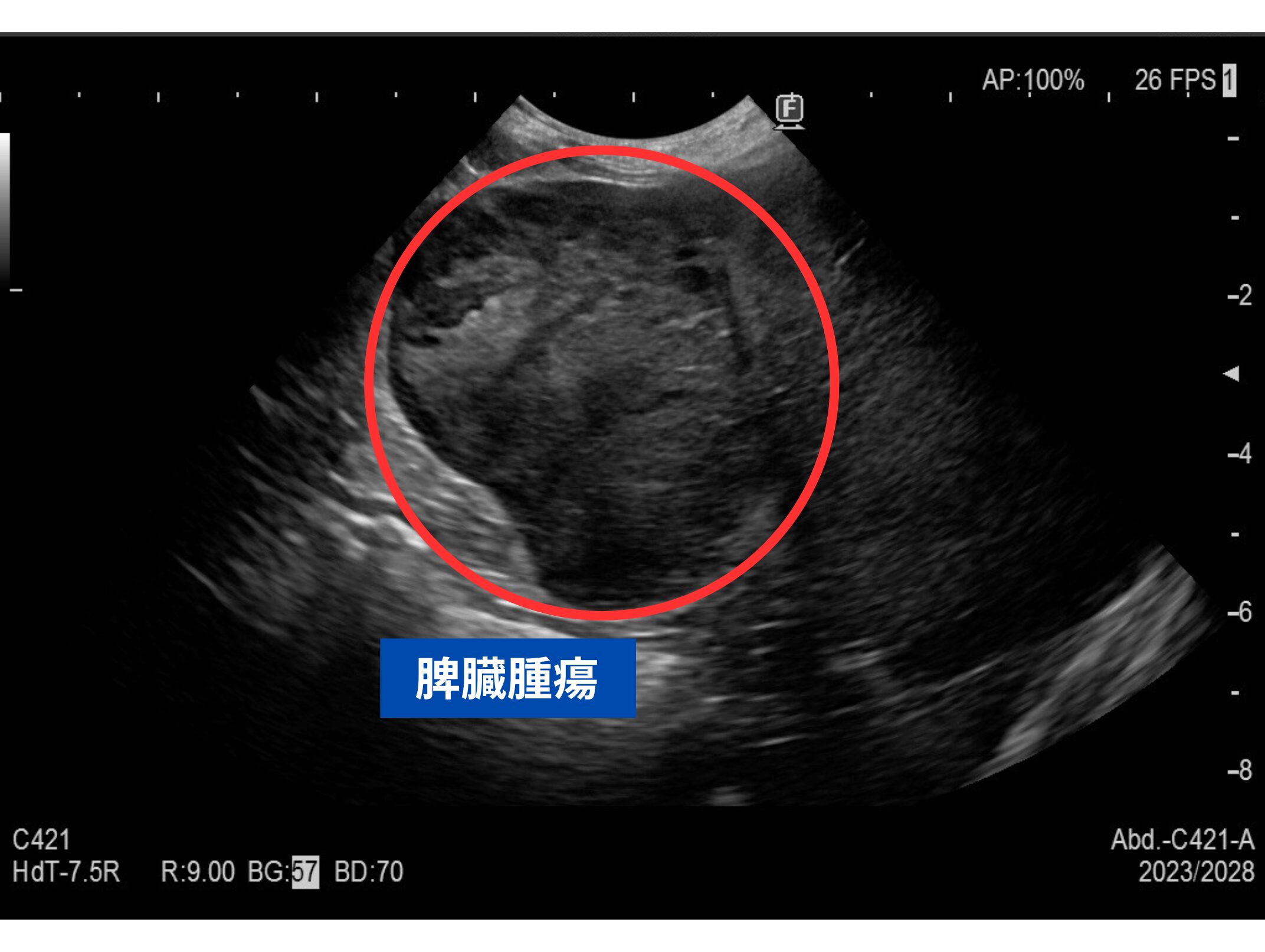 脾臓腫瘍エコー画像