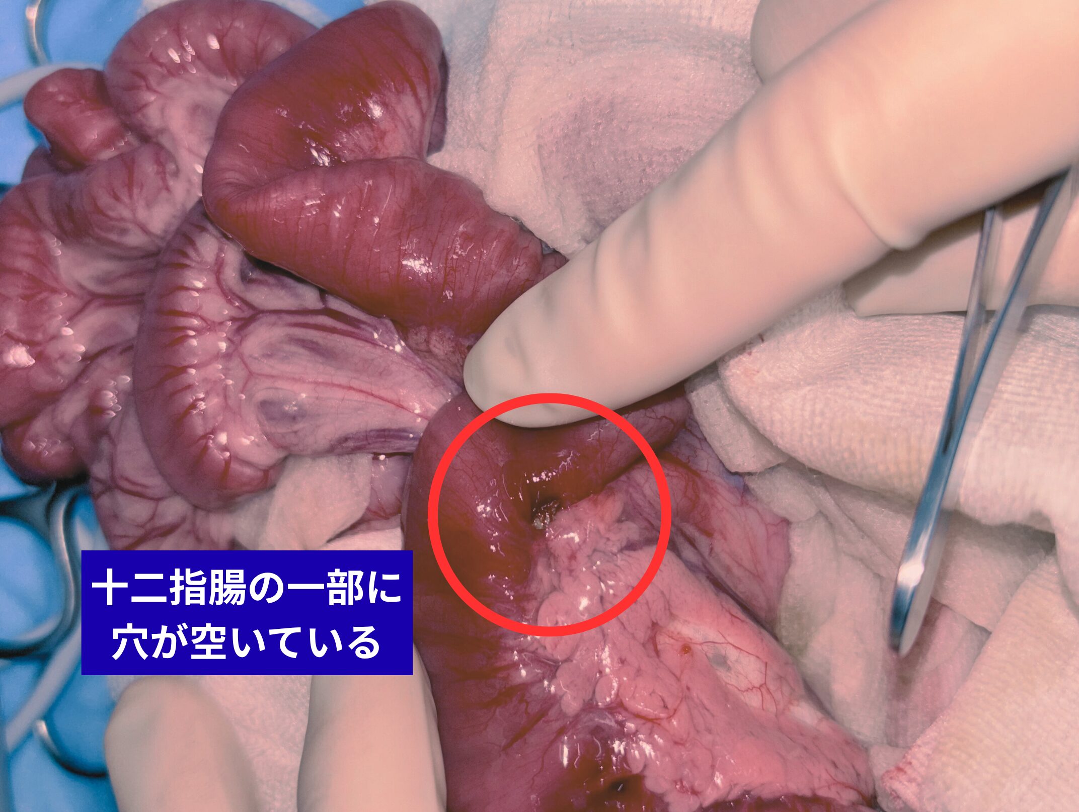 十二指腸の一部に穴が空いている様子