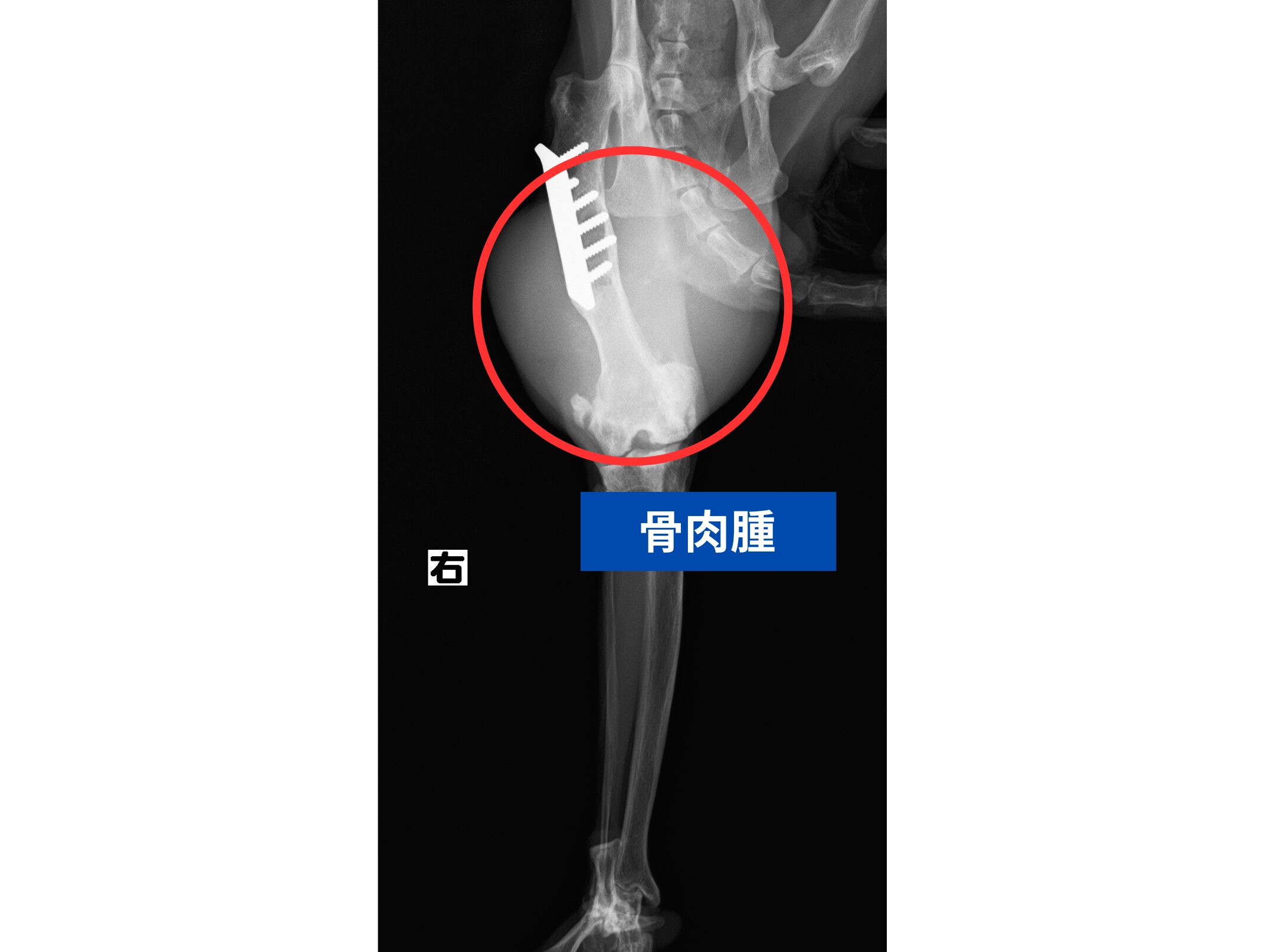 骨肉腫レントゲン画像